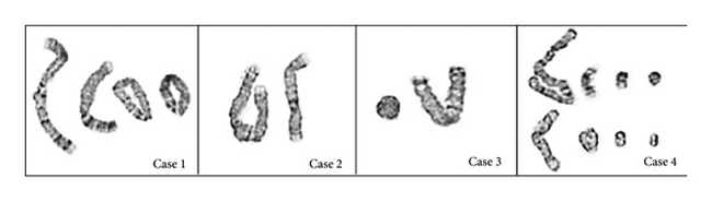 CG_Ring Chromosomes_resized.jpg